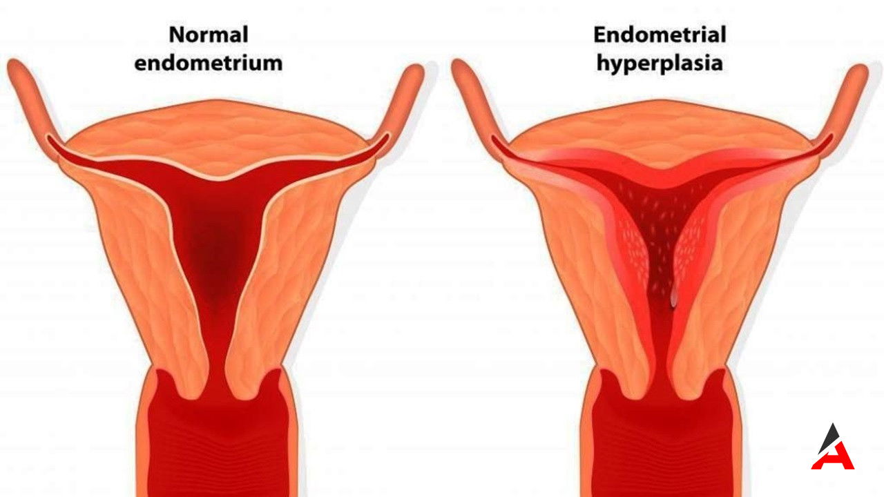 rahim-duvari-neden-kalinlasir-hormonal-dengesizlikler-ve-obezite-riskleri.jpg